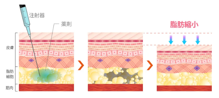 TCB脂肪溶解注射VFDIの効果