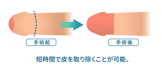 環状切除術イメージ