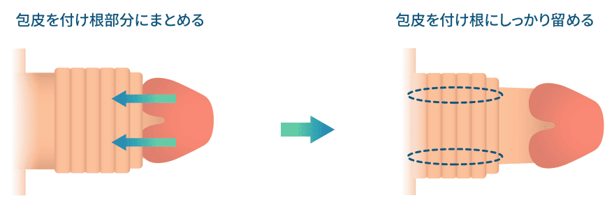 切らない包茎手術イメージ