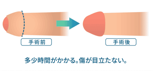 亀頭直下埋没法イメージ