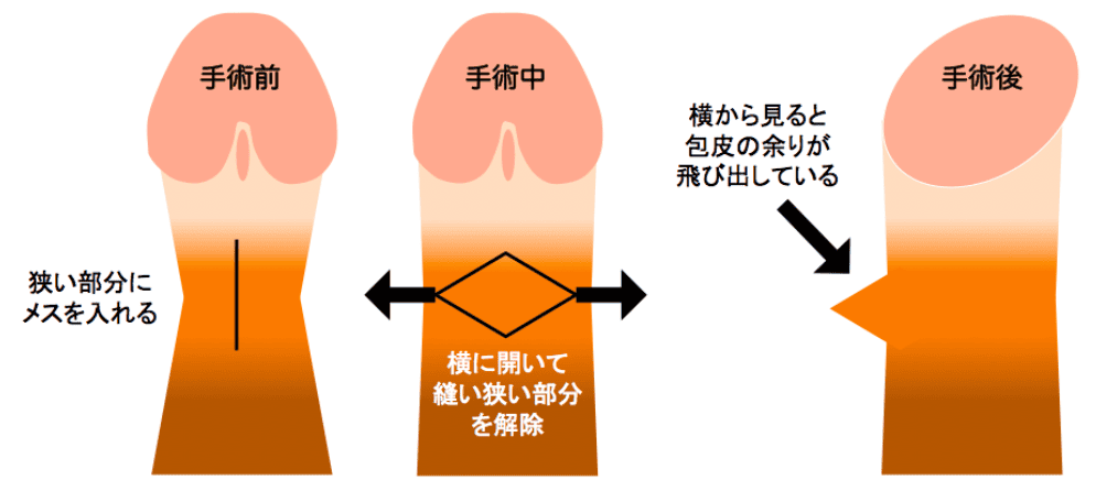 背面切開法イメージ