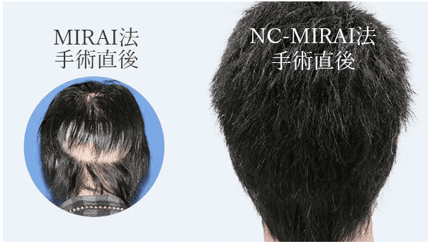 MIRAI法とNC-MIRAI法の手術比較画像